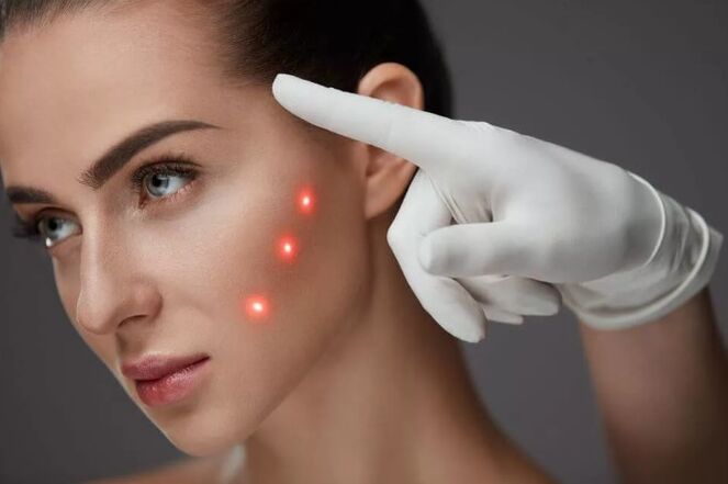 Skin laser
