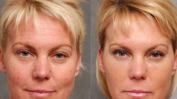 Before and after a living procedure
