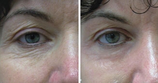 The skin around the eye laser